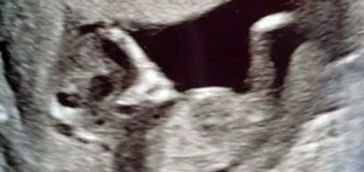 Remaja hamil terkejut selepas melihat wajah ‘muka makhluk asing’ tambahan dalam imbasan bayi