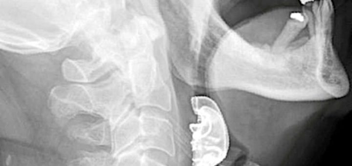 Warga emas tertelan gigi palsu ketika jalani pembedahan