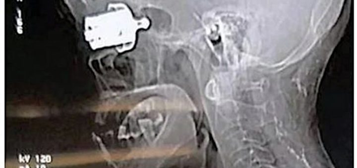 Wanita buta sebelah mata tertusuk wisel periuk tekanan