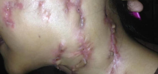 Urat Merah Melilit Leher & Akan Meletup, Pelajar Tahfiz 2 Tahun Derita Penyakit Misteri