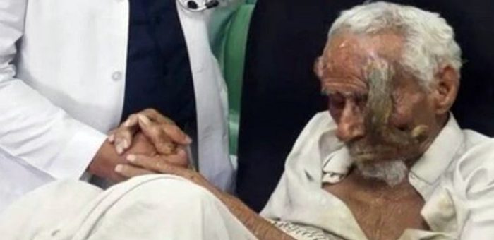 Lelaki bertanduk meninggal dunia pada usia 140 tahun selepas tanduknya cuba dipotong